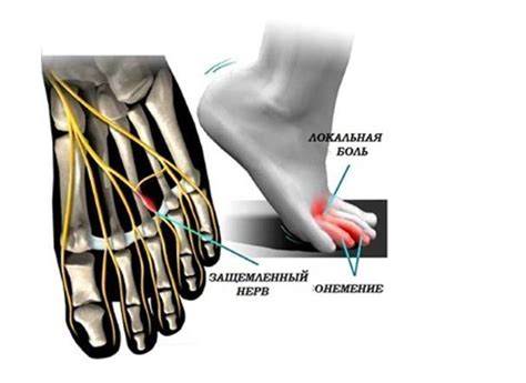 Диагностика и методы лечения невромы Мортона для восстановления здоровья