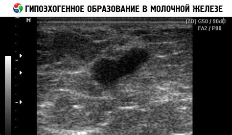 Диагностика и методы обнаружения гипоэхогенного образования