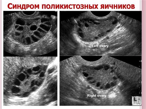 Диагностика наличия активных фолликулов в яичниках в период изменений гормонального фона организма