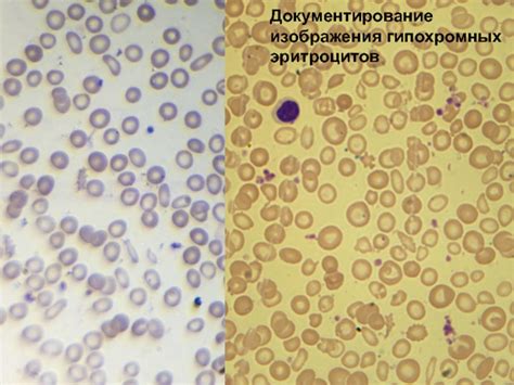 Диагностика повышения гипохромных эритроцитов