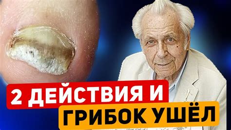 Домашние рецепты от грибка ногтей: использование перекиси водорода