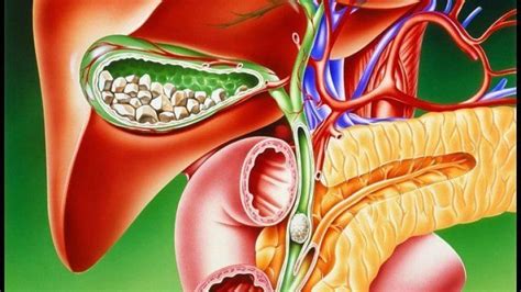 Желчекаменная болезнь: симптомы и причины
