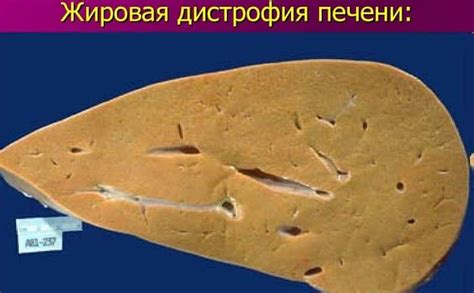 Жировая дистрофия печени