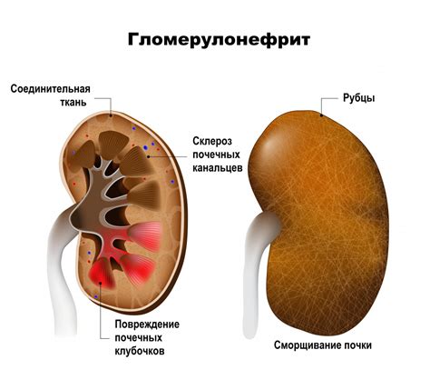 Заболевания правой почки и их клинические проявления