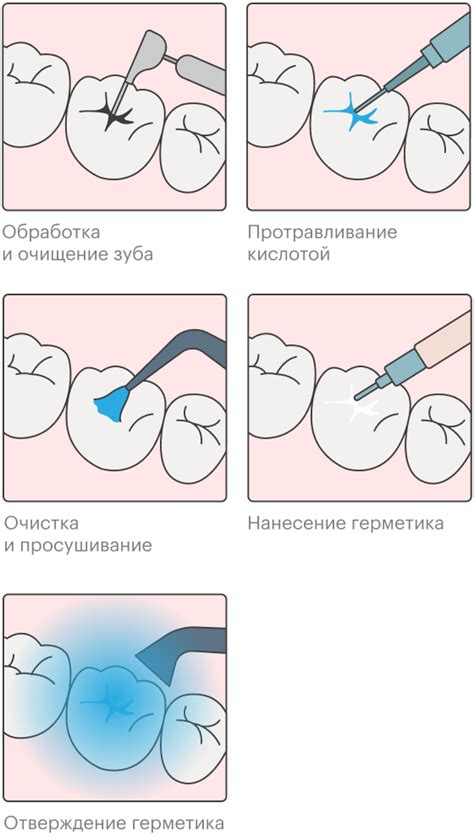 Зачем проводить герметизацию фиссур?