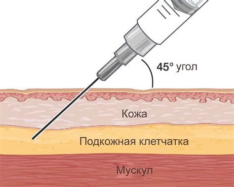 Значение подкожных инъекций в медицине