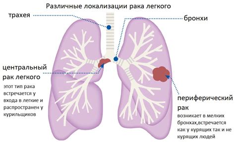 Значимость осознания факторов, связывающих онкологическое поражение легких с появлением отечности в нижних конечностях