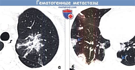 Значимость раннего выявления метастазов на КТ легких для пациентов