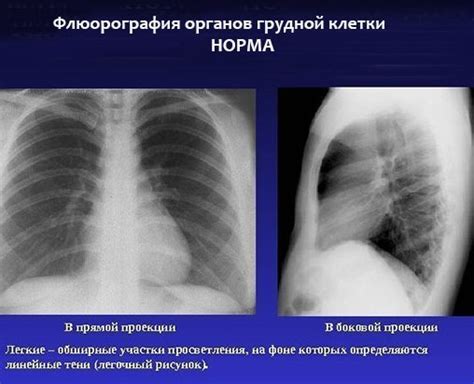 Значимость регулярного проведения флюорографии