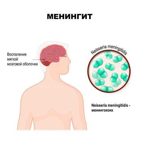 Инфекции и менингит