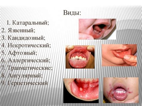 Какие признаки сопровождают стоматит у малышей и как они влияют на повседневную жизнь ребенка?