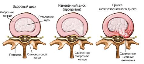 Как определить наличие грыжи позвоночника?