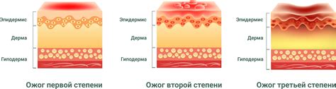 Как помочь при ожоге от этого лекарственного средства?