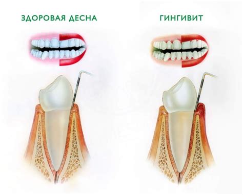 Как предотвратить зуд десен