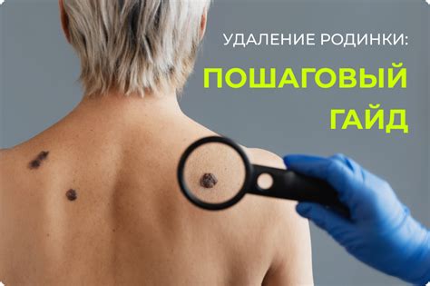 Как принять осознанное решение: сохранить или удалить родинку?