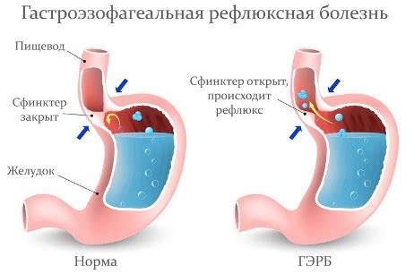 Классификация и стадии эзофагита