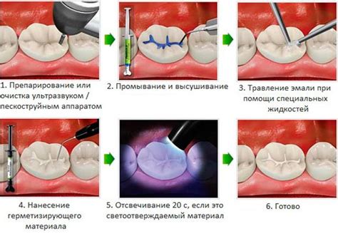 Кто нуждается в герметизации фиссур