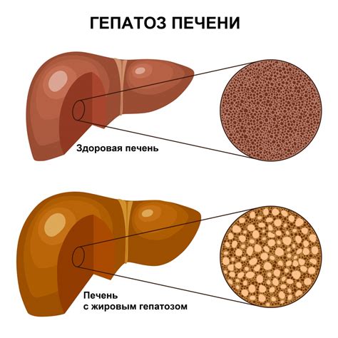 Лечение гепатомегалии при жировом гепатозе