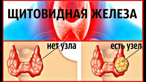 Лечение гетерогенных узлов щитовидной железы