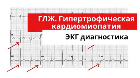 Лечение гипокинезии миокарда левого желудочка: