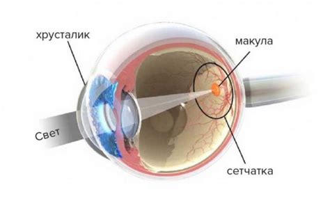 Лечение гипоплазии макулы глаза