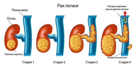 Лечение гипотрофии левой почки