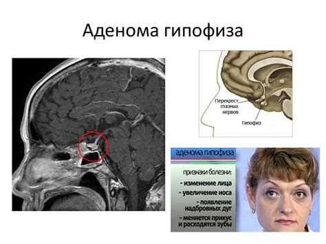 Лечение гипофиза: основные методы и подходы