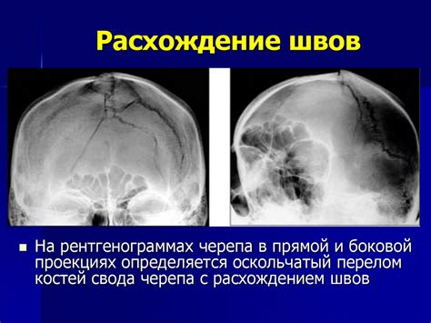 МР признаки внутричерепной гипертензии: основные симптомы и проявления