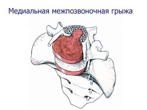 Медианная грыжа: понятие и симптомы