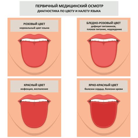 Медицинский аспект явления белых отложений на поверхности языка