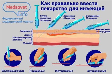 Места внутришнебедренных инъекций: как выбрать правильное место и избежать ошибок