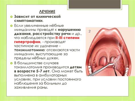 Методы диагностики гипертрофии носовых миндалин в Нижнем Новгороде