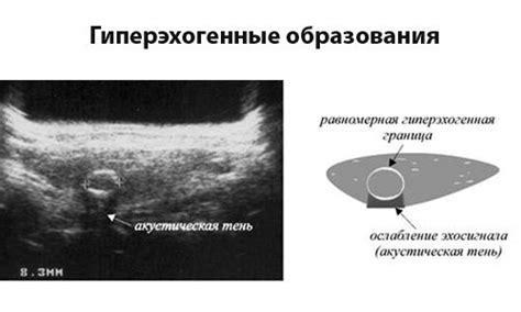 Методы лечения гипоэхогенных образований