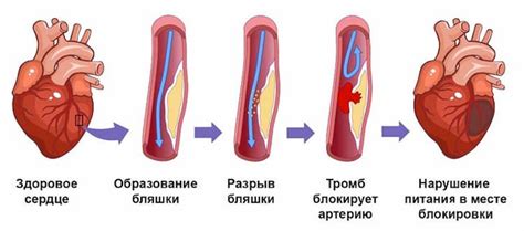 Методы лечения при проявлениях тромбоза в артериях сердца