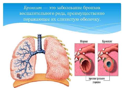 Механизм воздействия Амбробена на слизистую оболочку бронхов