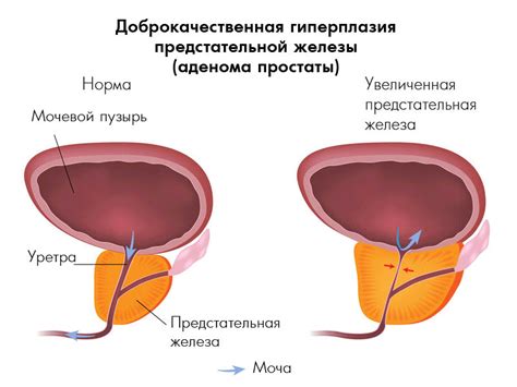 Механизм действия Афалазы и Омника при аденоме простаты: особенности и отличия