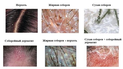 Натуральное решение проблемы себореи и перхоти