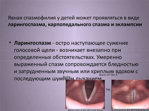 Необычные места проявления спазма диафрагмы у детей с атравматической аномалией положения верхушки плода