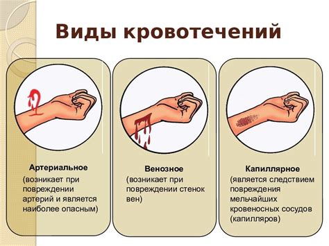 Определение времени остановки кровотечения