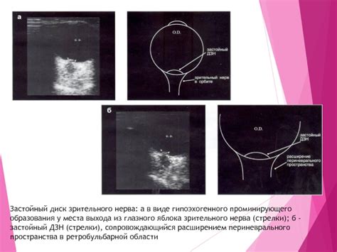 Определение гипоэхогенного образования