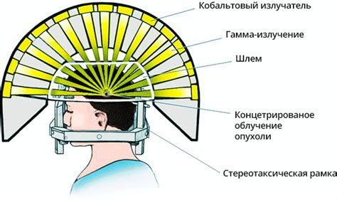 Определение наилучшего подхода к терапии: сравнение Гамма ножа и радиационного лечения