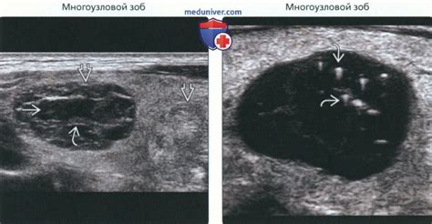 Осложнения гипоэхогенного неоднородного узла