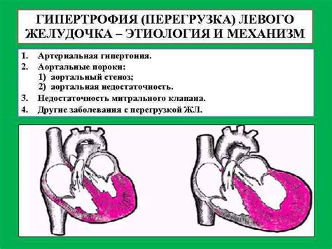 Осложнения при гипокинезии миокарда левого желудочка: