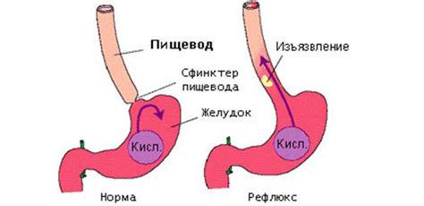 Осложнения эзофагита