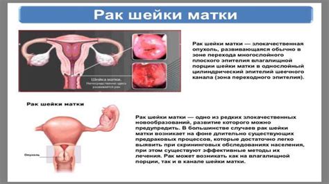 Основные причины гетерогенной структуры матки