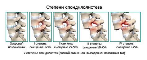 Основные проявления и сигналы о смещении в поясничном сегменте позвоночника