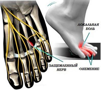 Основные характеристики и симптомы невромы Мортона: явления и признаки
