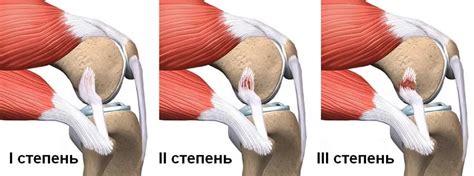 Основы использования холодных методов для смягчения растяжения связок: эффективные приемы и инструкции