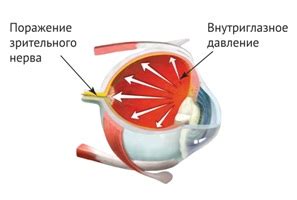 Основы повышенного внутриглазного давления