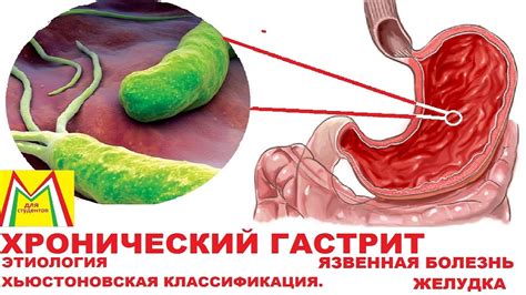 Острый гастрит: расстройство желудка и его проявления